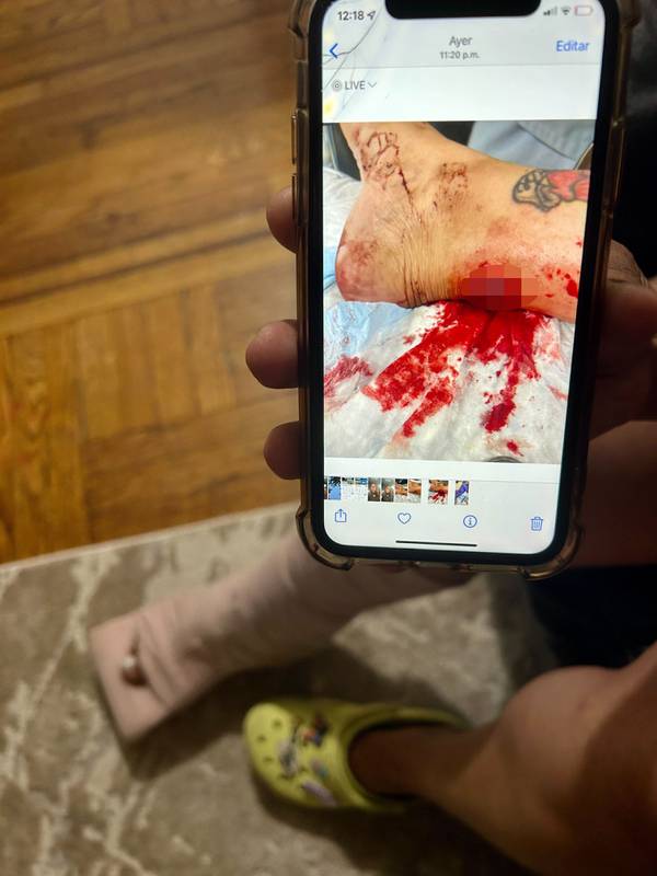 Maria Toribio shows a photo of her bullet wound above her now bandaged foot. Toribio was shot in the Bronx on Sunday. 